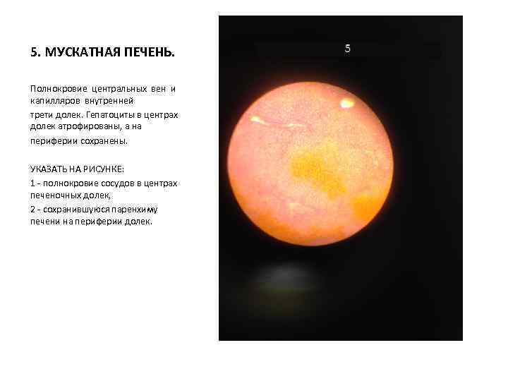 5. МУСКАТНАЯ ПЕЧЕНЬ. Полнокровие центральных вен и капилляров внутренней трети долек. Гепатоциты в центрах