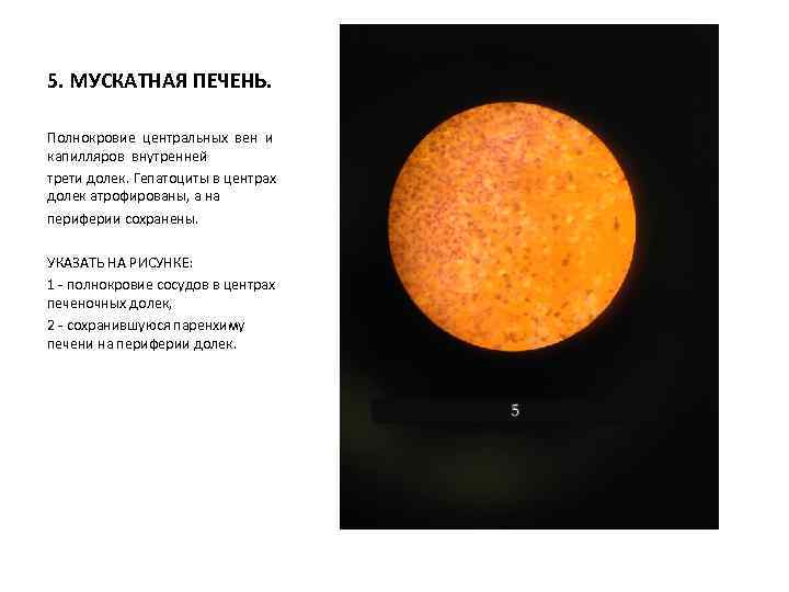 5. МУСКАТНАЯ ПЕЧЕНЬ. Полнокровие центральных вен и капилляров внутренней трети долек. Гепатоциты в центрах