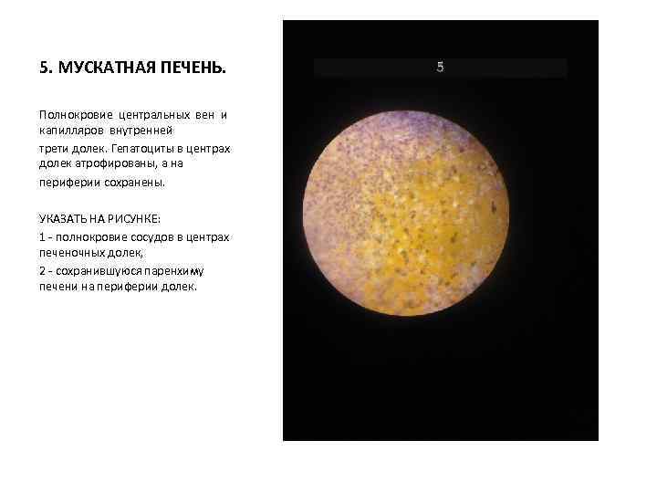 5. МУСКАТНАЯ ПЕЧЕНЬ. Полнокровие центральных вен и капилляров внутренней трети долек. Гепатоциты в центрах