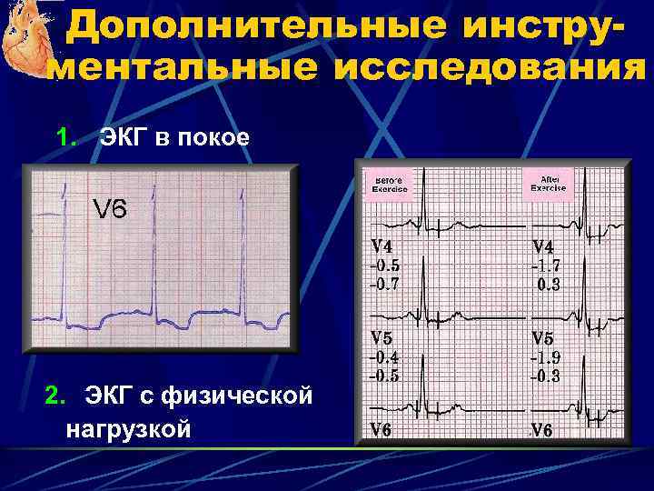 Дополнительные инструментальные исследования 1. ЭКГ в покое 2. ЭКГ с физической нагрузкой 