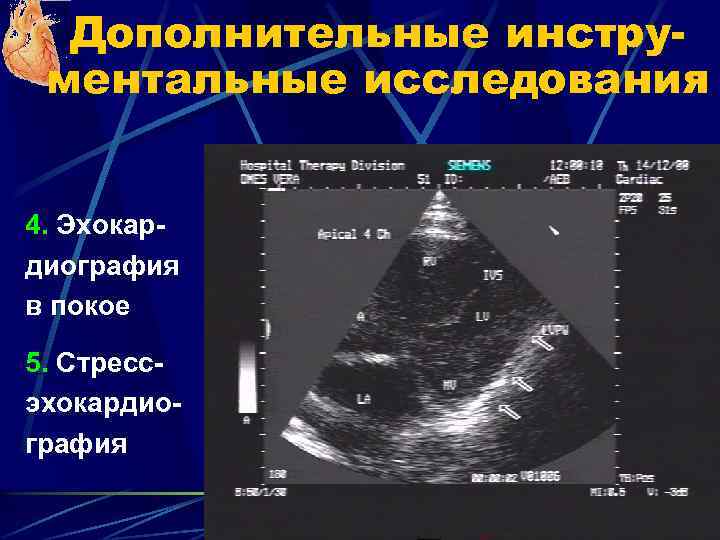 Дополнительные инструментальные исследования 4. Эхокардиография в покое 5. Стрессэхокардиография 