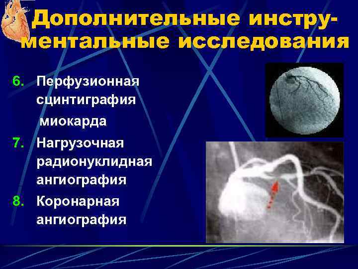 Дополнительные инструментальные исследования 6. Перфузионная сцинтиграфия миокарда 7. Нагрузочная радионуклидная ангиография 8. Коронарная ангиография