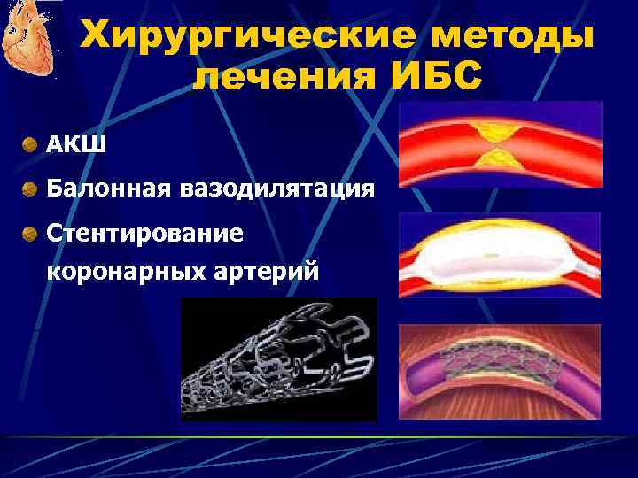 Хирургические методы лечения ИБС АКШ Балонная вазодилятация Стентирование коронарных артерий 
