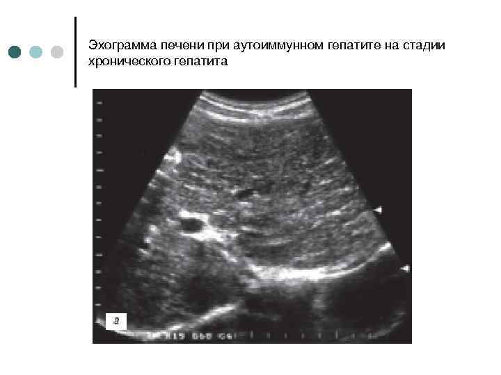 Эхограмма печени при аутоиммунном гепатите на стадии хронического гепатита 