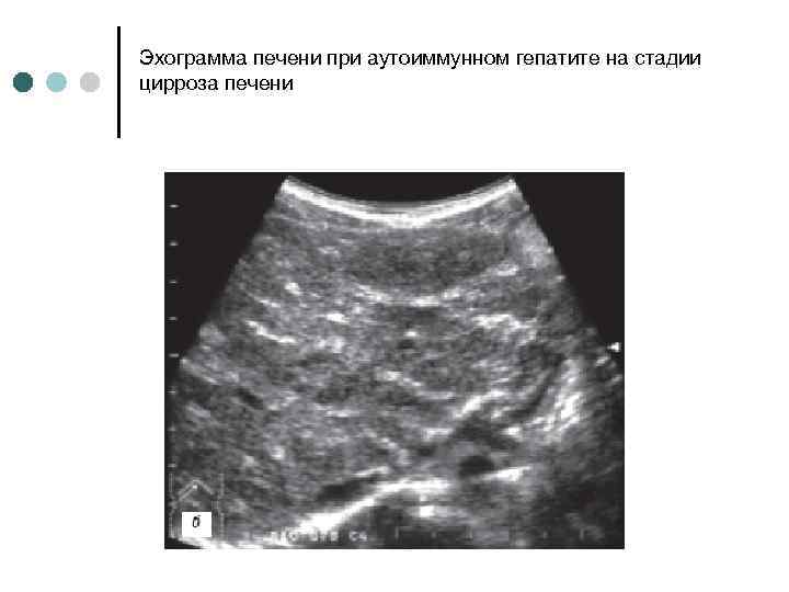 Эхограмма печени при аутоиммунном гепатите на стадии цирроза печени 