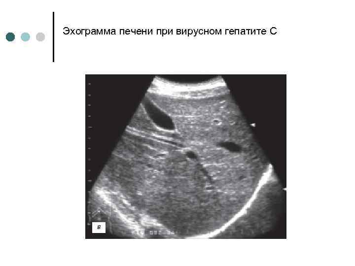 Эхограмма печени при вирусном гепатите С 