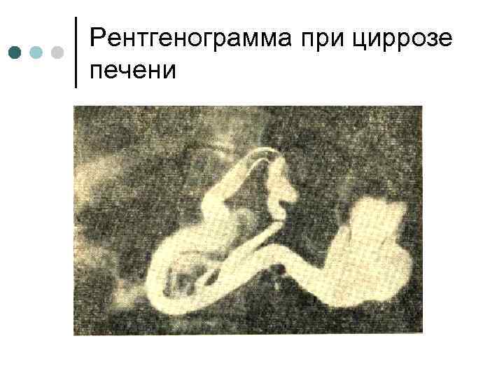 Рентгенограмма при циррозе печени 
