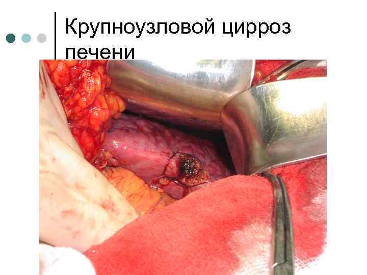 Крупноузловой цирроз печени 