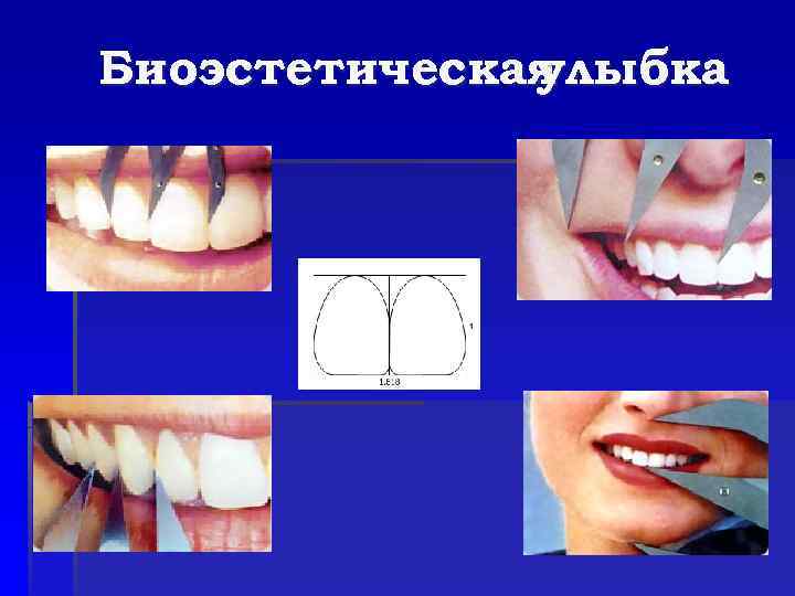 Биоэстетическая улыбка 
