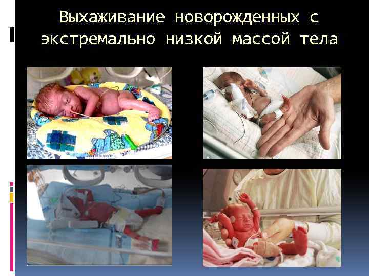 Выхаживание новорожденных с экстремально низкой массой тела 