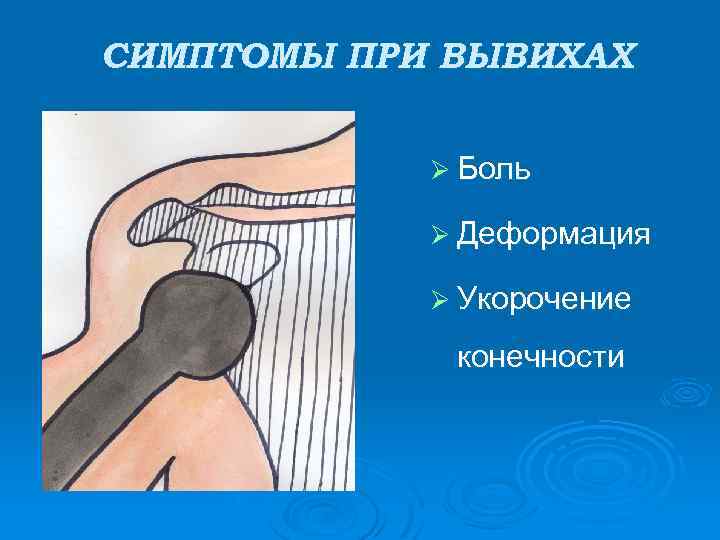 СИМПТОМЫ ПРИ ВЫВИХАХ Ø Боль Ø Деформация Ø Укорочение конечности 
