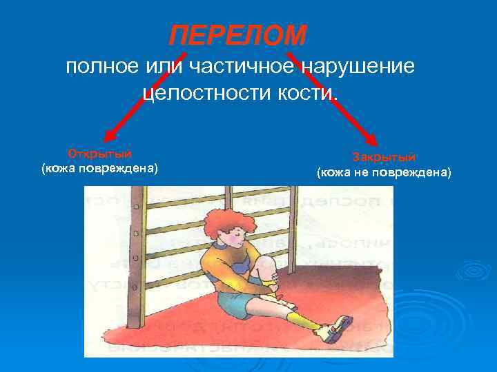 ПЕРЕЛОМ полное или частичное нарушение целостности кости. Открытый (кожа повреждена) Закрытый (кожа не повреждена)