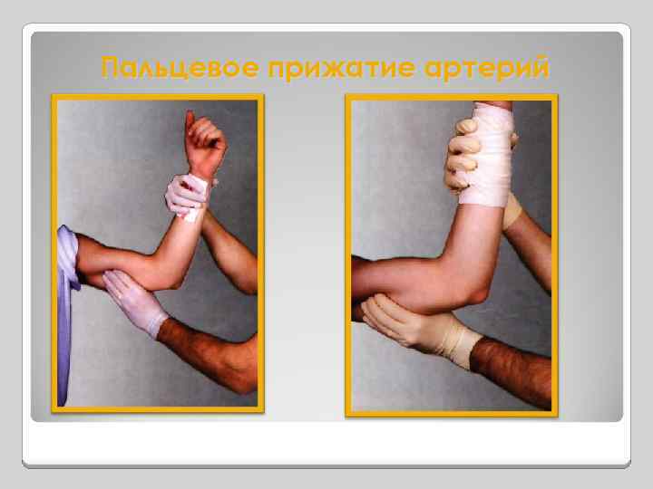 Пальцевое прижатие артерий 