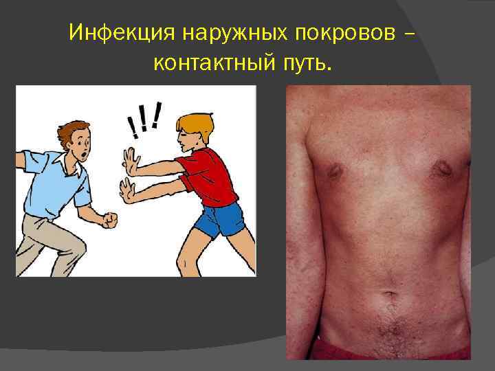 Инфекция наружных покровов – контактный путь. 