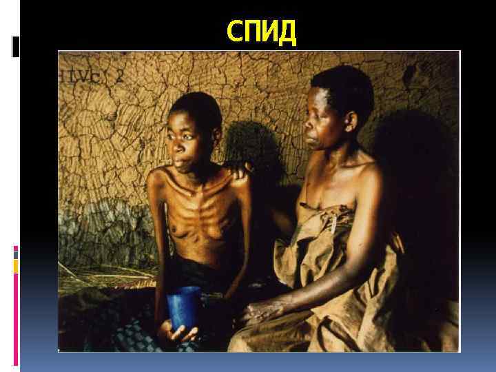 СПИД 