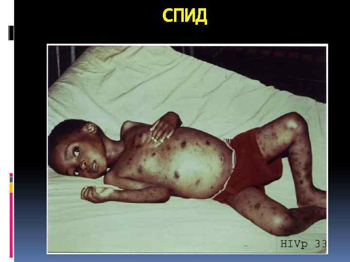 СПИД 