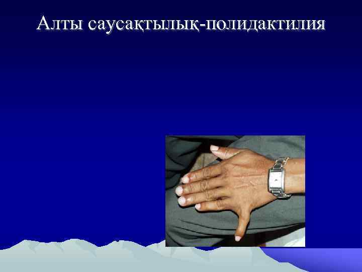 Алты саусақтылық-полидактилия 