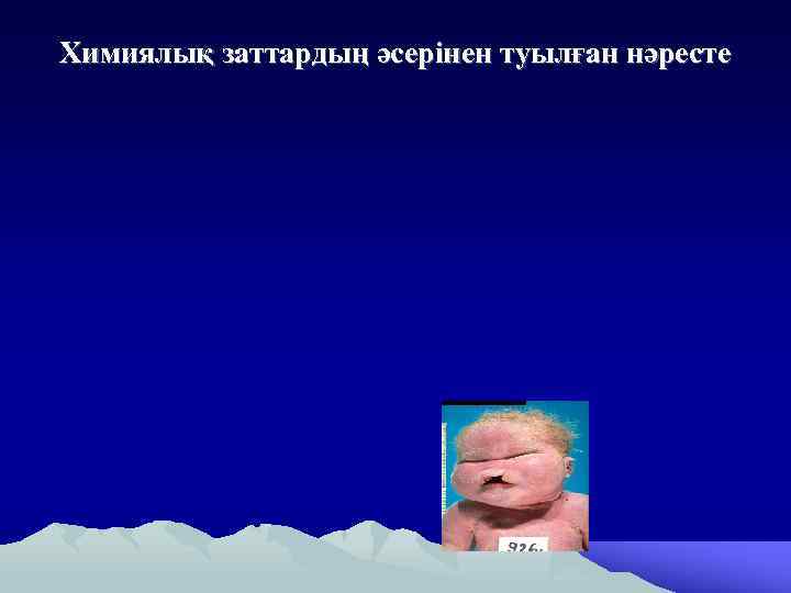 Химиялық заттардың әсерінен туылған нәресте 