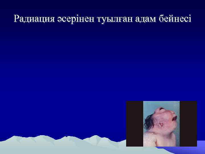 Радиация әсерінен туылған адам бейнесі 