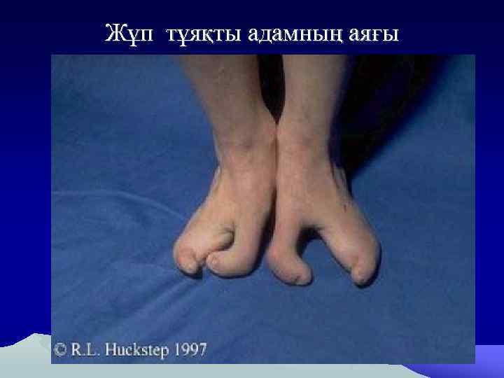 Жұп тұяқты адамның аяғы 