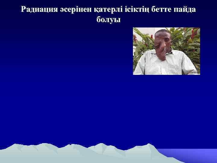 Радиация әсерінен қатерлі ісіктің бетте пайда болуы 
