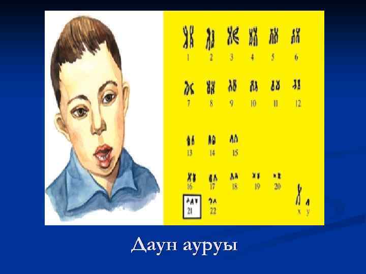 Даун ауруы 