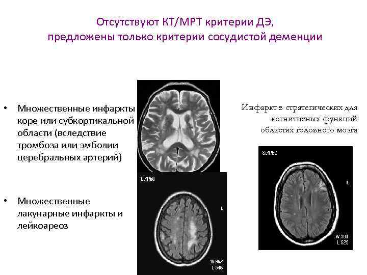 Отсутствуют КТ/МРТ критерии ДЭ, предложены только критерии сосудистой деменции • Множественные инфаркты в коре