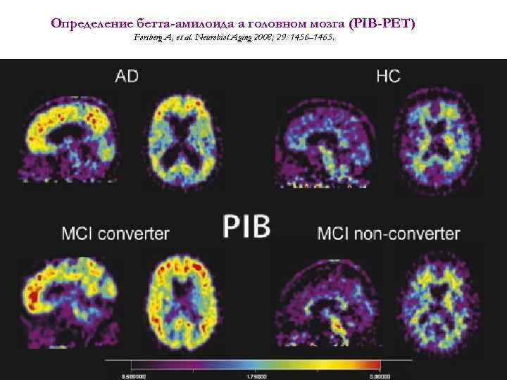 Определение бетта-амилоида а головном мозга (PIB-PET) Forsberg A, et al. Neurobiol Aging 2008; 29: