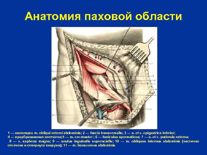Анатомия паховой области 1 — апоневроз m. obliqui externi abdominis; 2 — fascia transversalis;