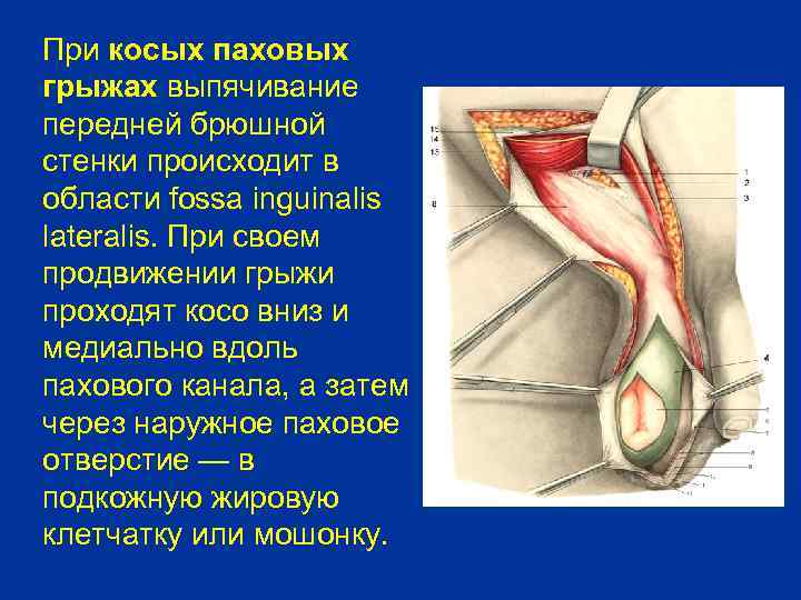 При косых паховых грыжах выпячивание передней брюшной стенки происходит в области fossa inguinalis lateralis.