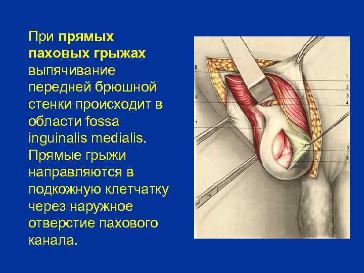 При прямых паховых грыжах выпячивание передней брюшной стенки происходит в области fossa inguinalis medialis.