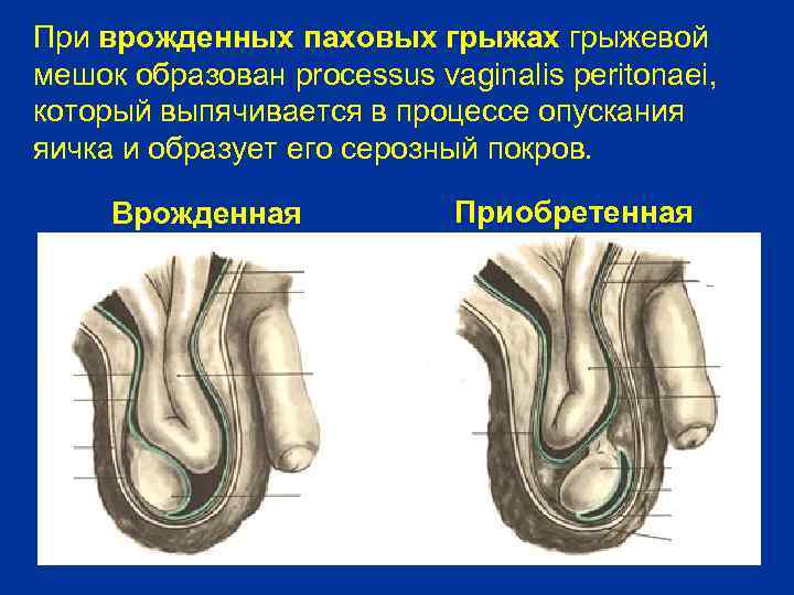 При врожденных паховых грыжах грыжевой мешок образован processus vaginalis peritonaei, который выпячивается в процессе