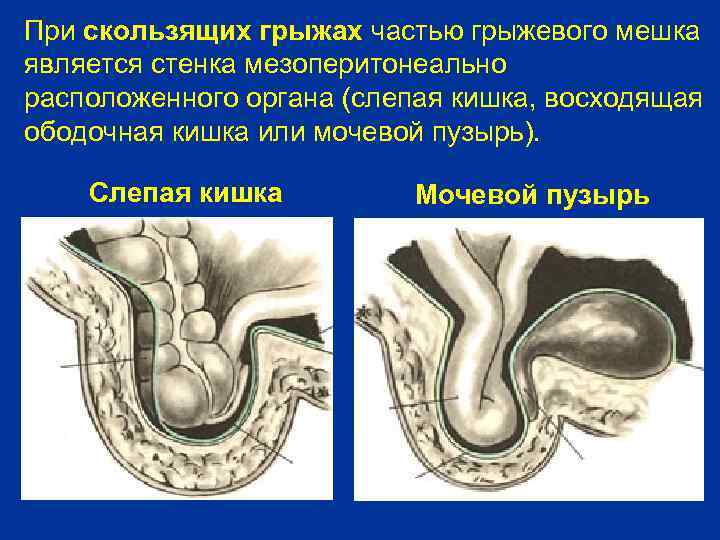 При скользящих грыжах частью грыжевого мешка является стенка мезоперитонеально расположенного органа (слепая кишка, восходящая