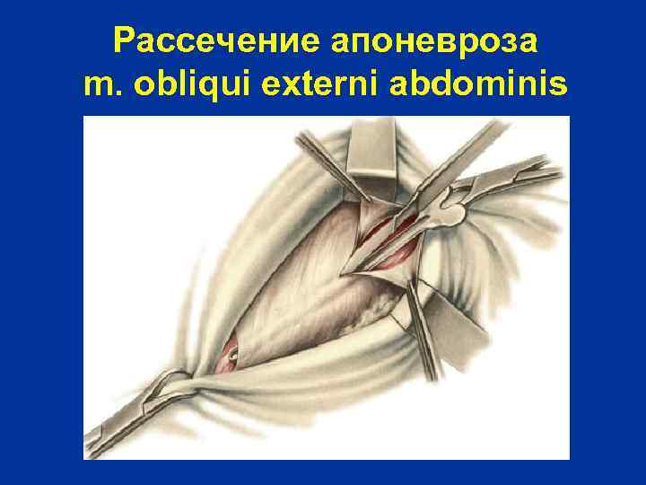 Рассечение апоневроза m. obliqui externi abdominis 