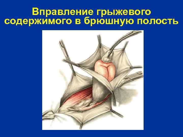 Вправление грыжевого содержимого в брюшную полость 