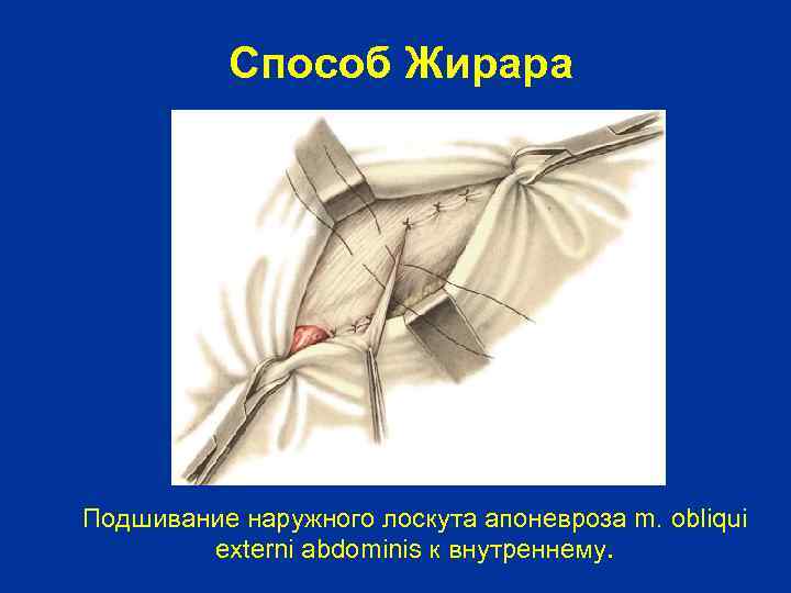 Способ Жирара Подшивание наружного лоскута апоневроза m. obliqui externi abdominis к внутреннему. 