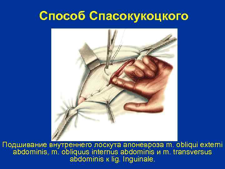Способ Спасокукоцкого Подшивание внутреннего лоскута апоневроза m. obliqui externi abdominis, m. obliquus internus abdominis