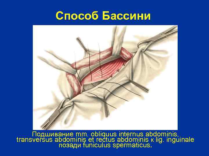 Способ Бассини Подшивание mm. obliquus internus abdominis, transversus abdominis et rectus abdominis к lig.
