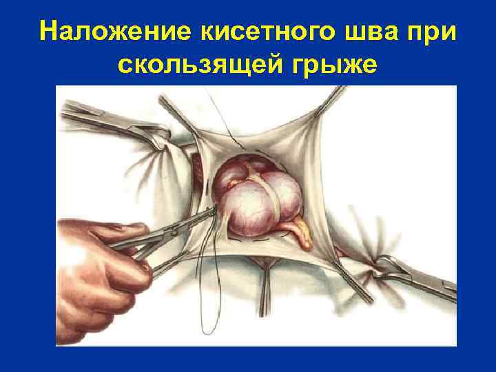 Наложение кисетного шва при скользящей грыже 