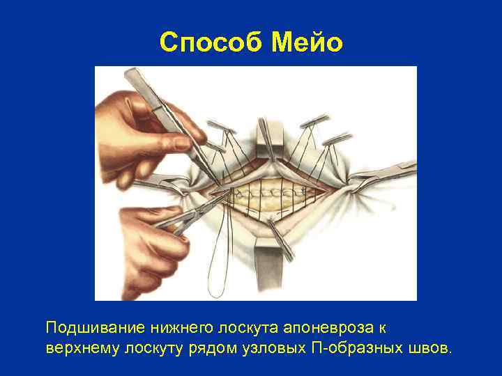 Способ Мейо Подшивание нижнего лоскута апоневроза к верхнему лоскуту рядом узловых П-образных швов. 