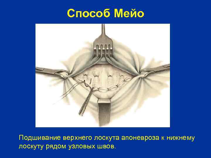 Способ Мейо Подшивание верхнего лоскута апоневроза к нижнему лоскуту рядом узловых швов. 