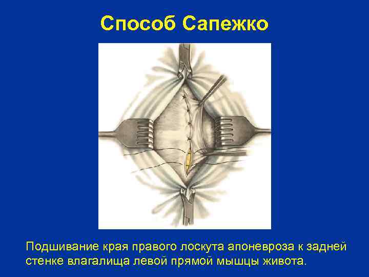 Способ Сапежко Подшивание края правого лоскута апоневроза к задней стенке влагалища левой прямой мышцы