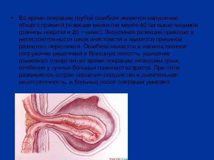  • Во время операции грубой ошибкой является нарушение общего правила резекции кишки (не