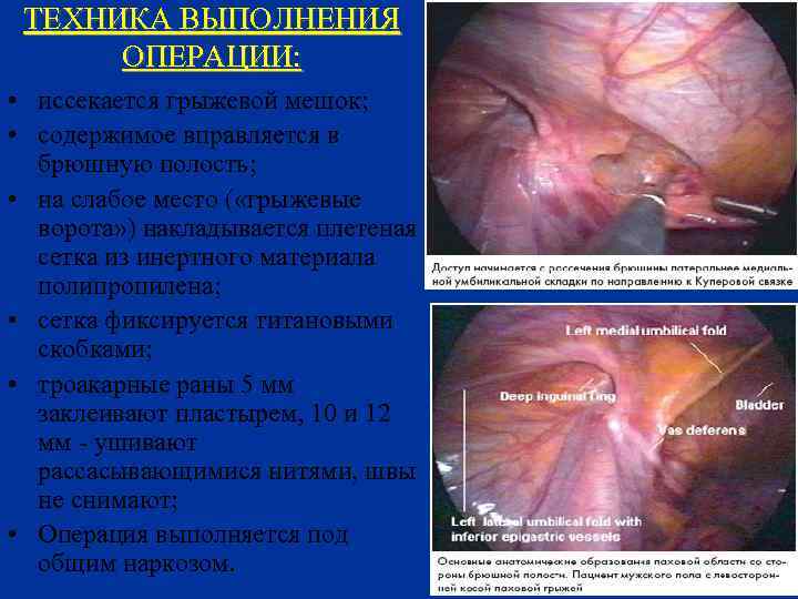 ТЕХНИКА ВЫПОЛНЕНИЯ ОПЕРАЦИИ: • иссекается грыжевой мешок; • содержимое вправляется в брюшную полость; •