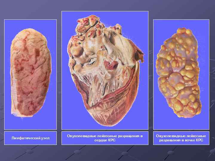 Лимфатический узел Опухолевидные лейкозные разращения в сердце КРС Опухолевидные лейкозные разращения в почке КРС