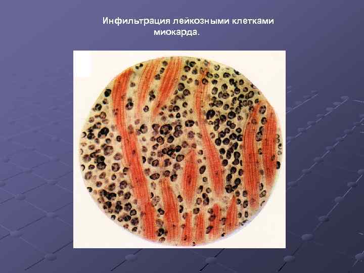  Инфильтрация лейкозными клетками миокарда. 