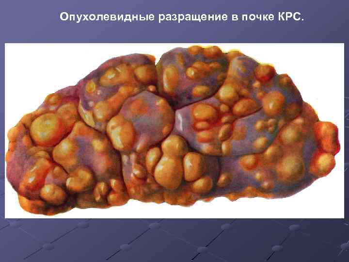 Опухолевидные разращение в почке КРС. 