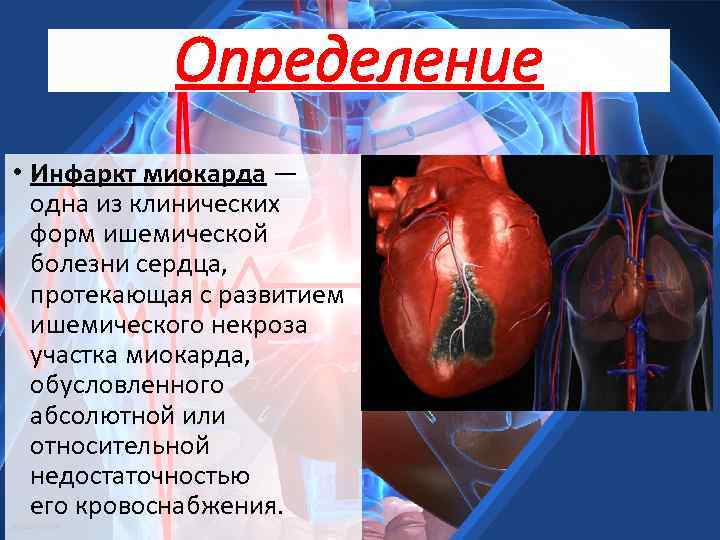 Определение • Инфаркт миокарда — одна из клинических форм ишемической болезни сердца, протекающая с