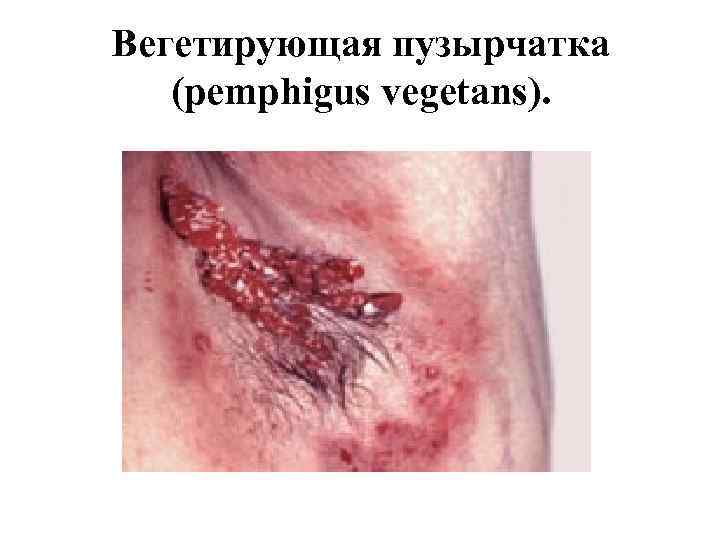 Вегетирующая пузырчатка (pemphigus vegetans). 