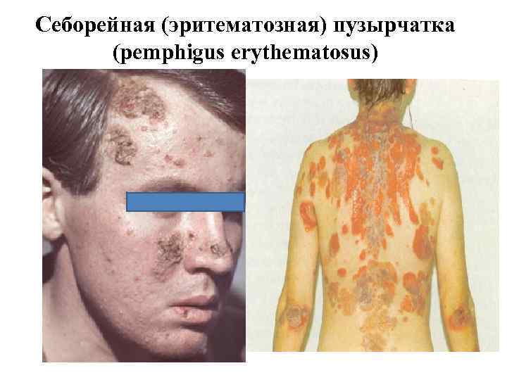 Себорейная (эритематозная) пузырчатка (pemphigus erythematosus) 